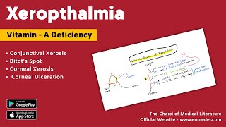 Xerophthalmia  Vitamin A deficiency  WHO Classification [upl. by Ecnarwal]