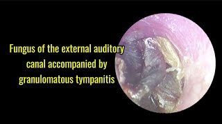 Fungus of the external auditory canal accompanied by granulomatous tympanitis [upl. by Leodora578]