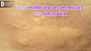 Detailed causes of URTICARIA or HIVES  Homeopathic Remedies DrVBhagyalakshmi  Doctors Circle [upl. by Nnednarb970]