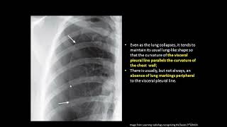 Lecture 7  Pneumothorax pneumomediastinum pneumopericardium and subcutanous emphesyma [upl. by Fauman113]