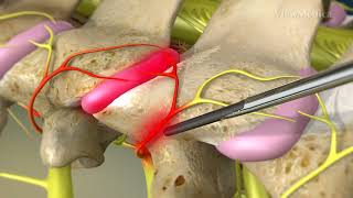 What is Cervical Facet Radiofrequency Neurotomy [upl. by Andris]