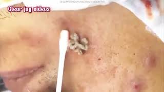 Big Cystic Acne Blackheads ExtractionBlackheads amp Milia Whiteheads Removal Pimple Popping [upl. by Eirual]