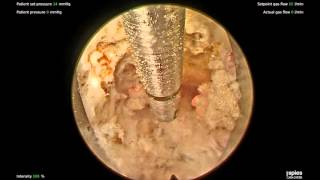 Endoscopic Lumbar Foraminoplasty for Scoliotic foraminal stenosis [upl. by Ailaro502]