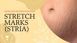 Stretch Marks Stria  CAUSES AND TREATMENT EXPLAINED  STRATUM DISTENSAE [upl. by Yhtrod]