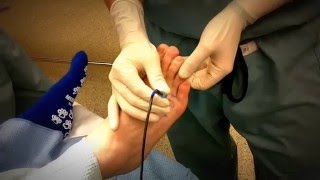 Radiofrequency Ablation For Painful Neuroma [upl. by Darcy]