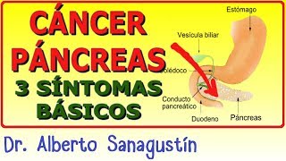 3 Síntomas del CÁNCER DE PÁNCREAS [upl. by Mik796]