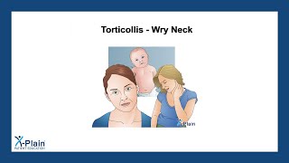 Torticollis  Wry Neck [upl. by Graaf657]