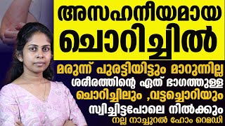 വട്ടച്ചൊറിയും ചൊറിച്ചിലും മാറ്റാൻ നല്ല നാച്ചുറൽ ഹോം റെമഡി ഇതാChorichil Maattaan [upl. by Pike]