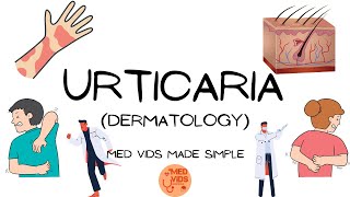 Urticaria  Dermatology Pathophysiologyclinical featuresdiagnosistreatment MedVidsMadeSimple [upl. by Enilrahc]