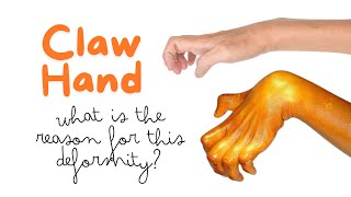 Claw hand is due to paralysis of what muscles Reason for clawing of hand handdeformity clawhand [upl. by Giffer]