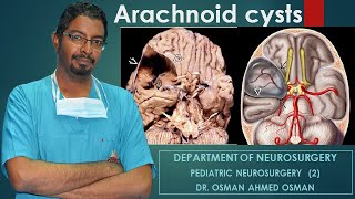 1 Arachnoid cysts Second Part [upl. by Zilber444]