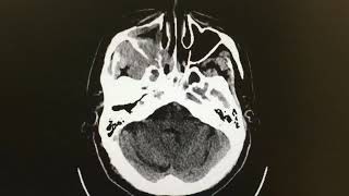 Paziente viene in pronto soccorso per diplopia TC cranio senza mezzo di contrasto [upl. by Federica]