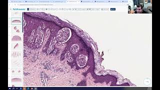 Avi Bitterman Dermpath Lecture 4 Melanocytic [upl. by Filahk273]