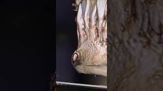 Bone erosion and an infection chinimplant jawlinesurgery facialplasticsurgery [upl. by Jimmy]