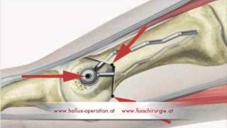 Hallux Operation nach Stoffella Teil 23 Osteotomie [upl. by Karola]