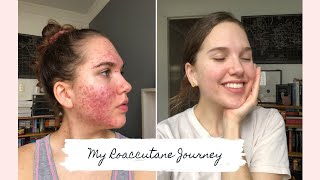 Roaccutane  My 6 Month Journey to Clear Skin [upl. by Radu]