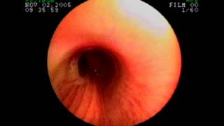 View a bronchoscopy during high frequency chest wall oscillation therapy [upl. by Sitnalta]