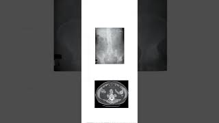 Case number 6 riglers Triad Look at the description for viva questionsviva casestudyradiology [upl. by Katonah]