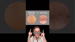 Blackheads vs Sebaceous Filaments Part 1 shorts [upl. by Eramal]