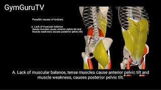 Possible causes of lordosis A lordotic position may be caused by a number of factors [upl. by Adrell]