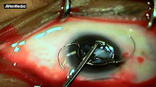 AIOC2018  VT123  Cataract Surgery in Severe Microphthalmos with Coloboma [upl. by Gemini788]