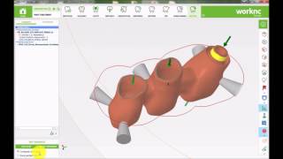 WorkNC Dental Prótesis Implanto Cementada [upl. by Blackstock]