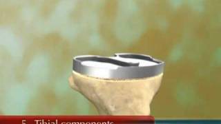 video knee surgical procedure for total knee replacement [upl. by Notned]