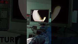 transurethral resection of the prostate [upl. by Emoreg]