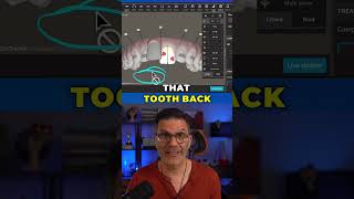 How to make teeth unmovable in the Invisalign ClinCheck software [upl. by Anuqahs423]