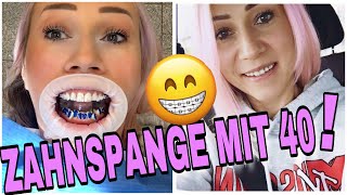 FESTE ZAHNSPANGE EINSETZEN😰 ABLAUF BRACKETS KLEBEN amp BEHANDLUNG  METALL oder KERAMIK [upl. by Gaye19]