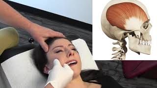 Temporal Headaches  Temporalis Muscle Internal Release Procedure  MSR Demo [upl. by Hofmann]