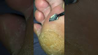 Clearing some itchy dead skin from between my toes [upl. by Hajan]