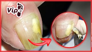 OVERGROWN INFECTED INGROWN TOENAIL REMOVAL PODOLOGIA EM UNHA ENCRAVADA [upl. by Roma]