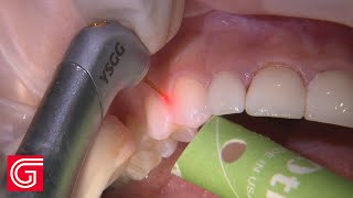 LASER Gingivectomy for Obsidian® Veneers Teeth 6  11  1 of 4 [upl. by Anaizit]