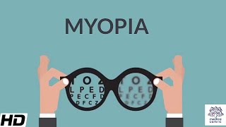 Myopia Signs and Symptoms Causes Diagnosis and Treatment [upl. by Ehcropal]