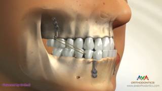 Orthodontic Treatment for Underbite or Crossbite  Bone Anchored Maxillary Protraction [upl. by Acsirp]