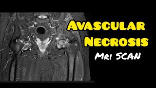 Avascular necrosis  Osteonecrosis  MRI HIP JOINT  Radiology [upl. by Jeannette]