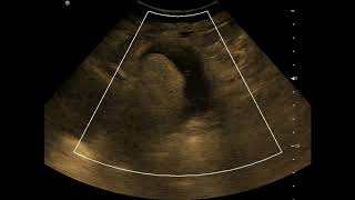 Complex Adnexal Mass  Dermoid Cyst  Ultrasound  Case 23 [upl. by Florry]