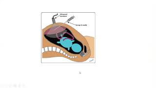 CVS procedure  Chorionic Villus Sampling in Tamil [upl. by Ayhtak]