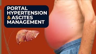 Portal HypertentionAscitesRefractory ascites managment Decompensated liver Complications [upl. by Dorreg666]