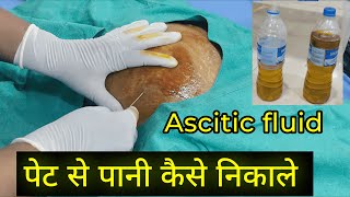 Ascites Fluid tapping Procedure  Dr Subodh SKP [upl. by Hafler170]