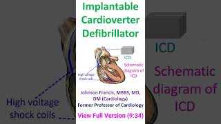 Implantable Cardioverter Defibrillator [upl. by Chessy943]