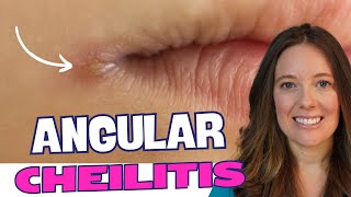 Best Lip Treatment for Angular Cheilitis [upl. by Strickler524]