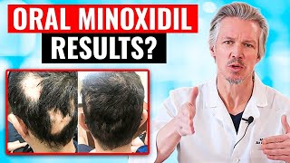 20000 PEOPLE TOOK ORAL MINOXIDIL AND THIS HAPPENED [upl. by Pelligrini]