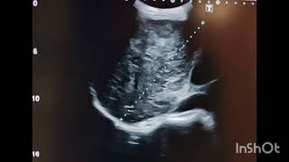 portal vein thrombus  multiple hyperechoic solid areas in liver [upl. by Nedarb432]