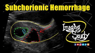 Subchorionic Hemorrhage  Ultrasound  Case 258 [upl. by Ecraep]