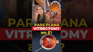 What is Pars plana Vitrectomy [upl. by Melvena]