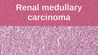 Renal Medullary Carcinoma  Pathology mini tutorial [upl. by Olli]