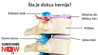 DISKUSHERNIJAlecenje bez operacijezivot bez bola DISCUS HERNIATION  treatment without surgery [upl. by Innig492]