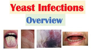 Candidal Yeast Infections Overview  Oral Thrush Vaginal Intertrigo Esophageal Candidiasis [upl. by Haswell]